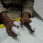 Kecelakaan Kerja Berulang, Bardi Kehilangan Tiga Jari di PT Dexin Steel Indonesia