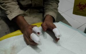 Kecelakaan Kerja Berulang, Bardi Kehilangan Tiga Jari di PT Dexin Steel Indonesia